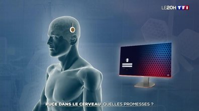 Puces implantées dans le cerveau : quelles promesses ?